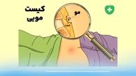 کیست مویی ؛ بیماری خاموش نشیمنگاهی و روش‌های قطعی درمان