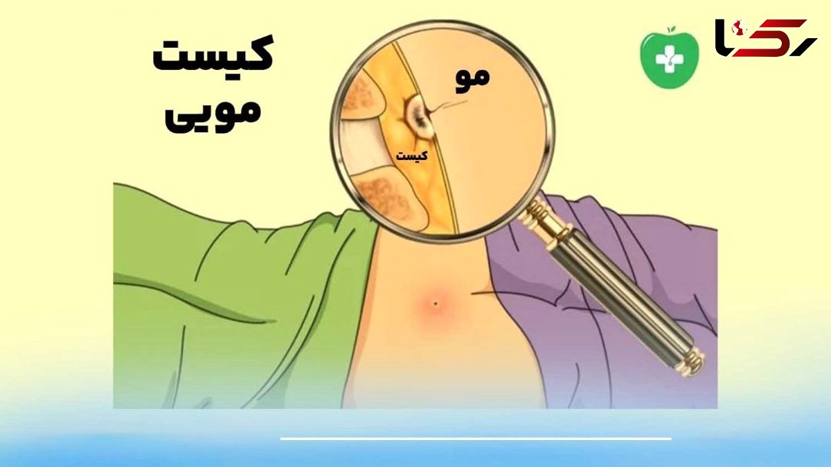 کیست مویی ؛ بیماری خاموش نشیمنگاهی و روش‌های قطعی درمان