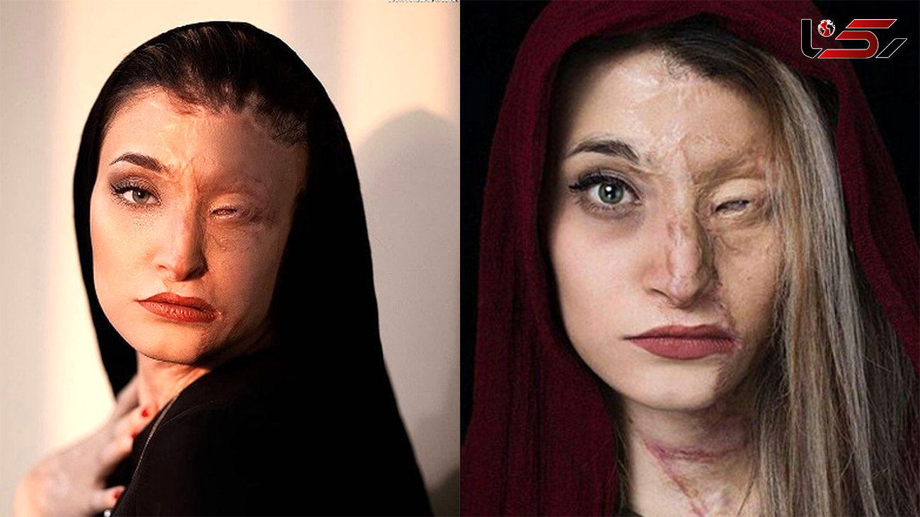  زیبایی جادویی دختر اسیدسوخته بعد 8 سال / مرضیه ابراهیمی عروس شد ! + عکس های جذاب عروسی اش