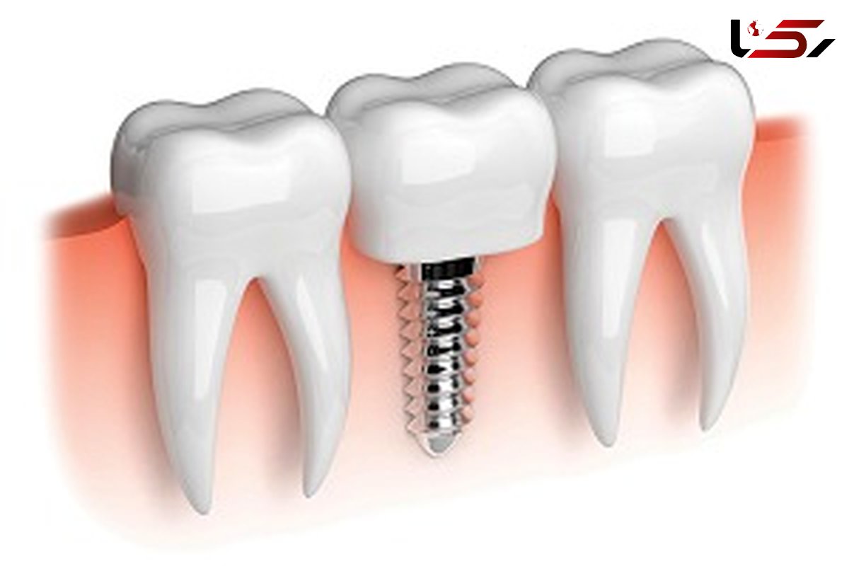 ایمپلنت دندان برای کدام بیماران دیابتی مفید است؟