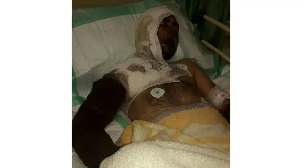 حمله اسیدی به عروس و داماد جوان خلخالی + عکس 