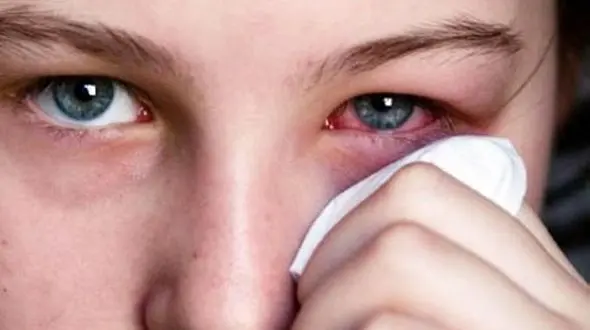 ناخنک چشم سبب بروز آستیگماتیسم می شود