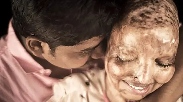 عکس این عروس سوخته جهان را تکان داد! / کینه اسیدی!+  عکس ها