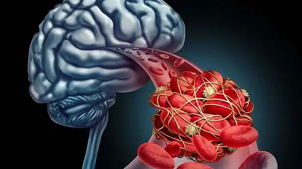 نشانه‌های مهم سکته مغزی کدام اند؟