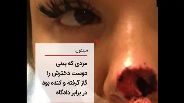 تشریح دادگاه مردی که بینی دوست دخترش را خورده بود+ عکس 