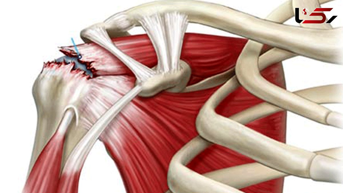 همه چیز درباره پارگی تاندون ها + فیلم