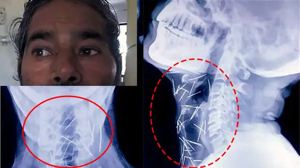 پزشکان از جراحی این مرد می ترسند/ 75 سوزن در گردن و بدن این مرد در حرکت هستند +تصاویر