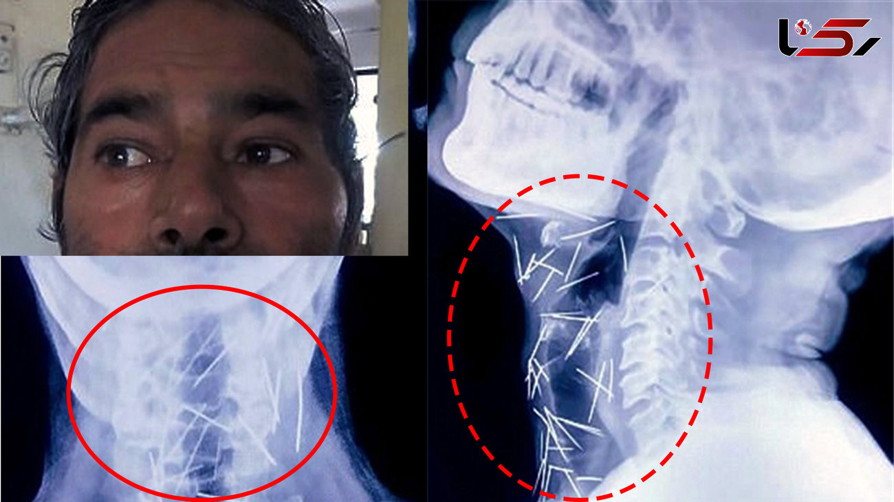 پزشکان از جراحی این مرد می ترسند/ 75 سوزن در گردن و بدن این مرد در حرکت هستند +تصاویر