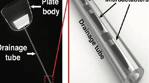 درمان قطعی آب سیاه چشم/ با کاشت ابزار پیشرفته در بدن