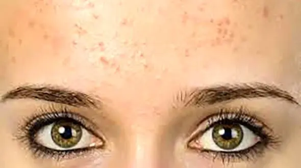 چطور  جوش های پیشانی را نابود کنیم؟