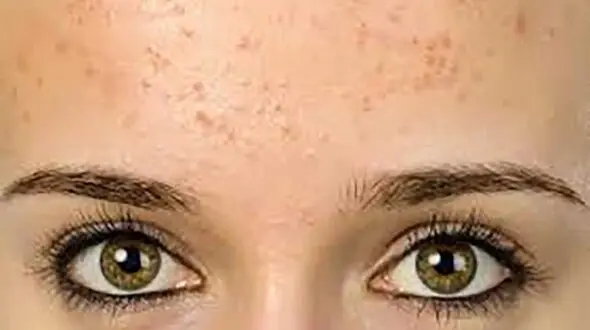 چطور  جوش های پیشانی را نابود کنیم؟