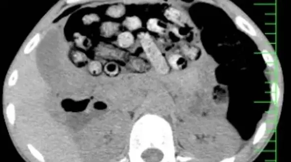 کشف 90 بسته مواد مخدر از معده و روده یک بیمار در کرج