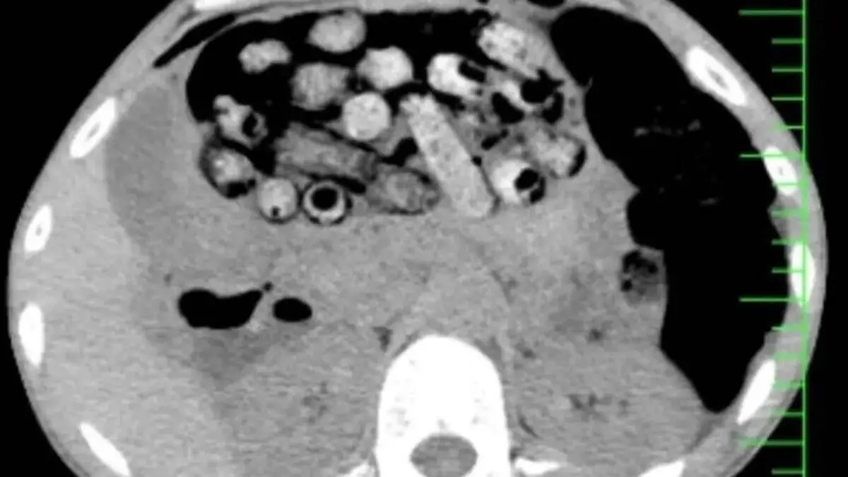 کشف 90 بسته مواد مخدر از معده و روده یک بیمار در کرج