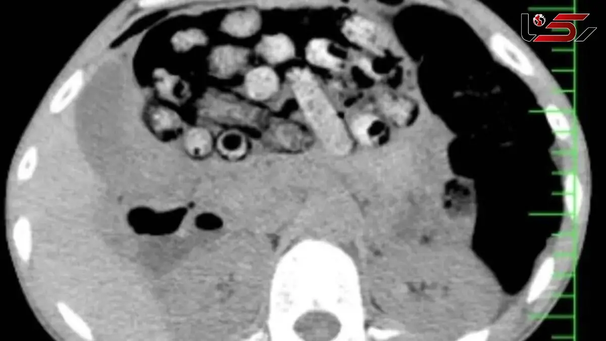 کشف 90 بسته مواد مخدر از معده و روده یک بیمار در کرج