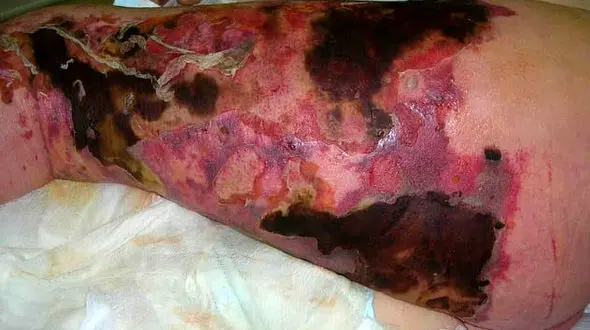 بلای وحشتناکی که باکتری های گوشت خوار سر این چند نفر آوردند+ تصاویر هولناک
