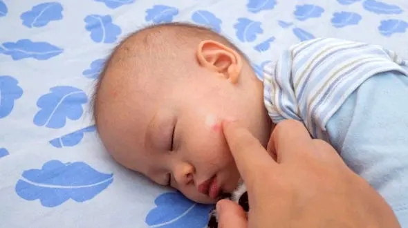 عفونت‌های قارچی و کودک شما