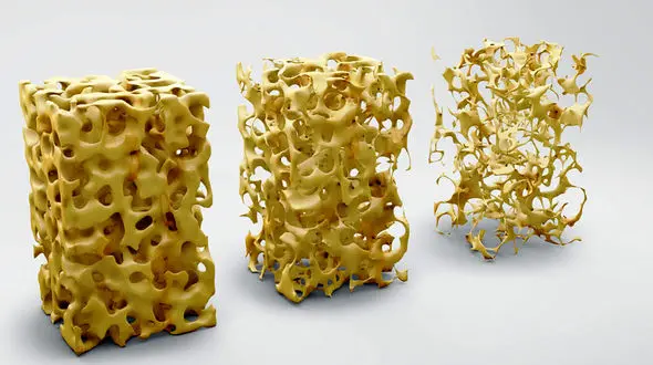 پوکی استخوان در چه سنی خانم ها و آقایان را درگیر می کند؟