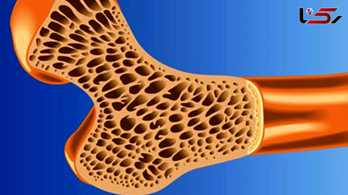  46 درصد زنان و 28 درصد مردان بالای 50 سال پوکی استخوان دارند / کاهش هورمون های جنسی خطر ابتلا به پوکی استخوان را افزایش می دهد