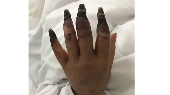 زخمی کوچک انگشتان دست یک زن را به صورت وحشتناکی خورد +عکس+16