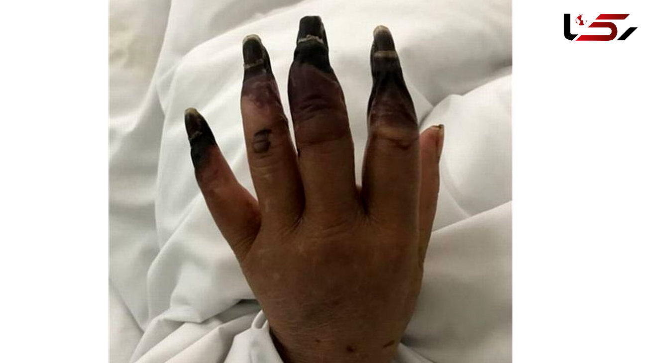 زخمی کوچک انگشتان دست یک زن را به صورت وحشتناکی خورد +عکس+16