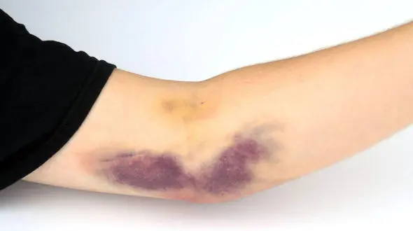 راز پشت کبودی‌ ها: اختلالی ناشناخته در بدن شما