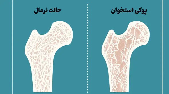 همه چیز درباره پوکی استخوان + فیلم