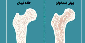 پوکی استخوان از چند سالگی شروع می شود؟