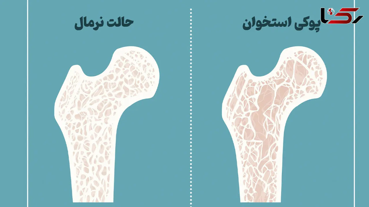 پوکی استخوان از چند سالگی شروع می شود؟