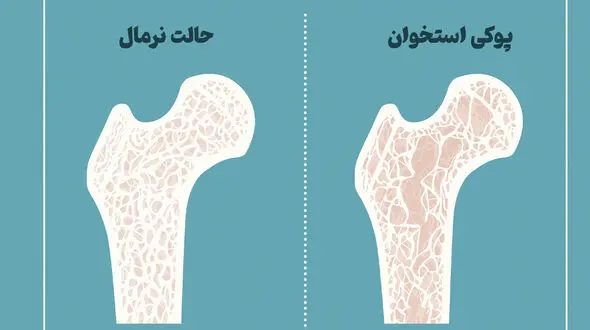 پوکی استخوان از چند سالگی شروع می شود؟