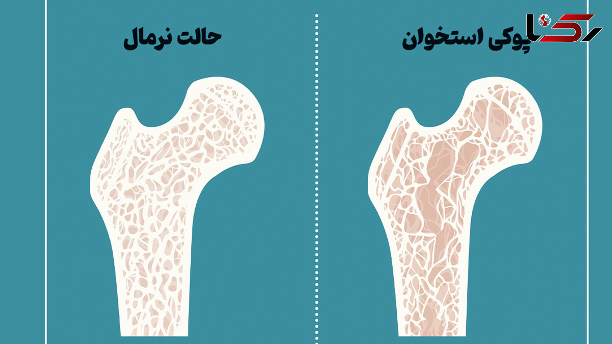 همه چیز درباره پوکی استخوان + فیلم