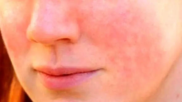 بیماری لوپوس چیست؟ + علائم 