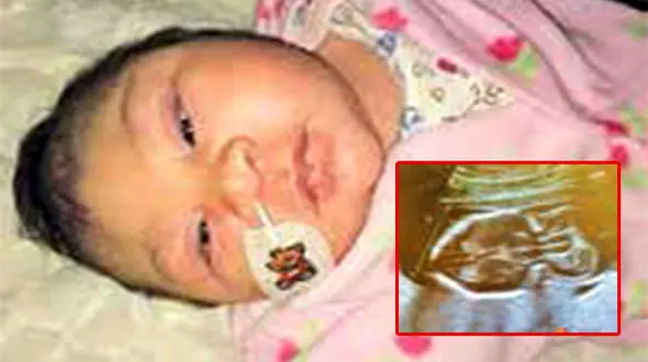 مغز یک نوزاد را به سرش بازگرداندند + عکس