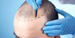 بهترین کلینیک کاشت مو آقایان در الهیه