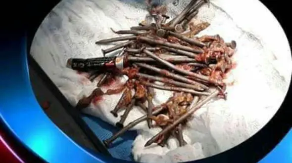 دختر 18 ساله عراقی یک کیلو میخ بلعیده بود + عکس