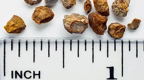 چطور از شر سنگ کلیه خلاص شویم؟