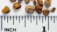 چطور از شر سنگ کلیه خلاص شویم؟