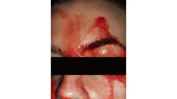 این زن خون عرق می‌کند!+ عکس های باورنکردنی