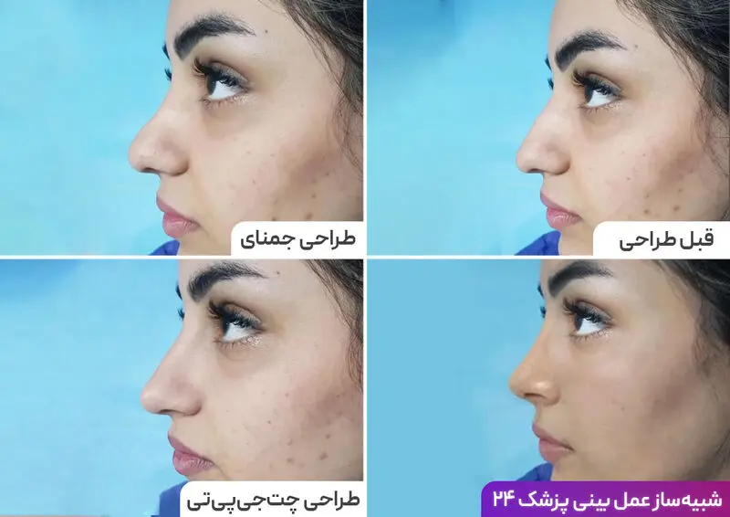 مقایسه طراحی و شبیه سازی عمل بینی پزشک 24 با سایر ابزارهای هوش مصنوعی
