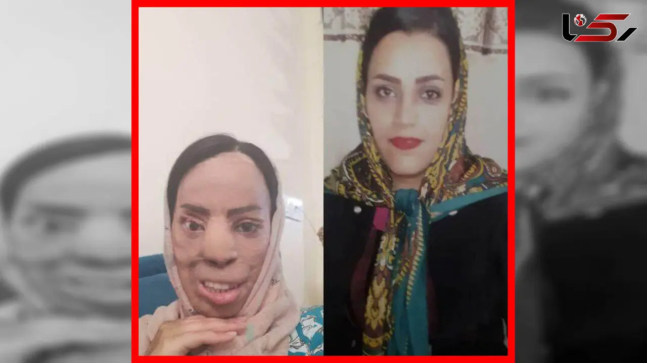 اسیدپاشی در افسریه چهره زیبای این زن را وحشتناک کرد+ عکس
