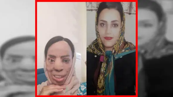 اسیدپاشی در افسریه چهره زیبای این زن را وحشتناک کرد+ عکس