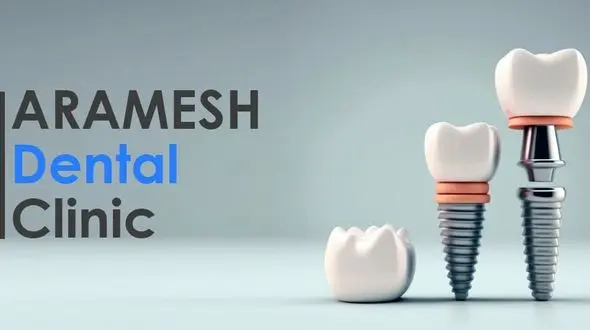 قیمت و هزینه ایمپلنت کره ای 1402