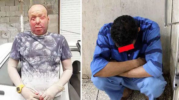عکس تکاندهنده از پسر تهرانی که با اسید سوخته شد + جزییات