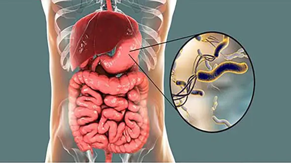 میکروب معده چیست؟ / راه درمان