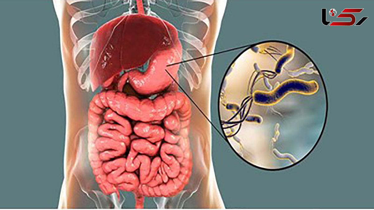 میکروب معده چیست؟ / راه درمان