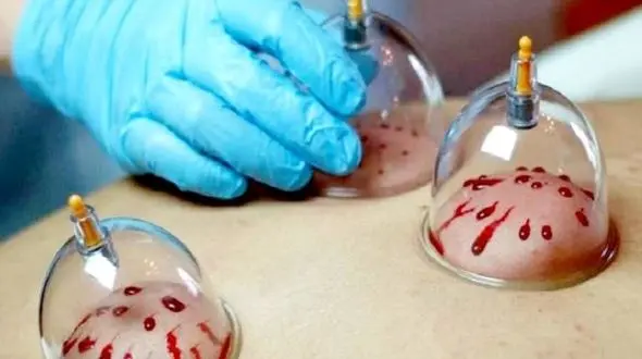 نکات مهم حجامت کرونایی‌ها 