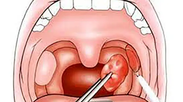 ارتباط لوزه سوم با شب ادراری کودکان