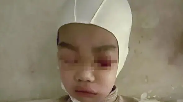 تنبیه  سخت / پوست سر و جمجمه کودک از هم جدا شد + عکس