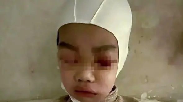 تنبیه  سخت / پوست سر و جمجمه کودک از هم جدا شد + عکس