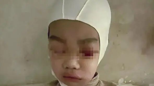 تنبیه  سخت / پوست سر و جمجمه کودک از هم جدا شد + عکس
