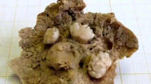 کشف تومور تخمدان 500 ساله +عکس 